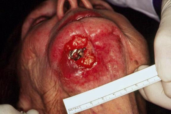 Basal-cell carcinoma | definition of Basal-cell carcinoma ...
