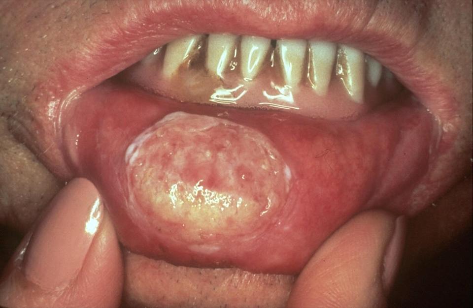 cancer-of-the-lip1.jpg